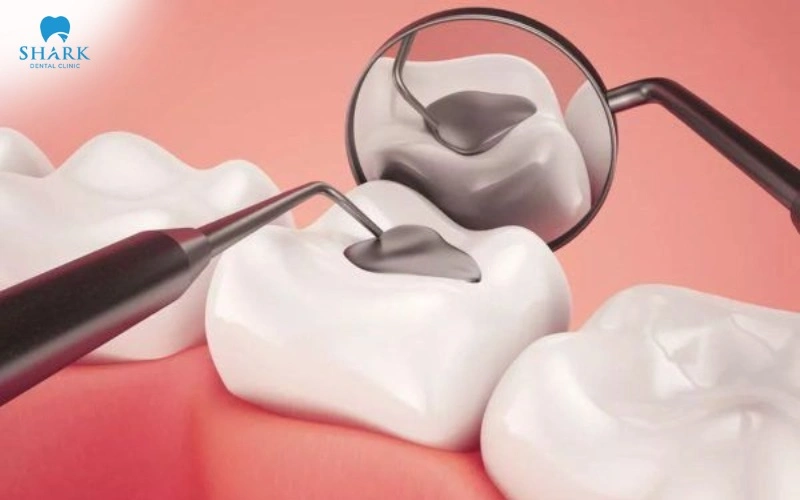 Bác sĩ thường sẽ chỉ định trám răng trước khi thực hiện tẩy trắng nhằm khôi phục hình dáng và đảm bảo an toàn cho sức khỏe