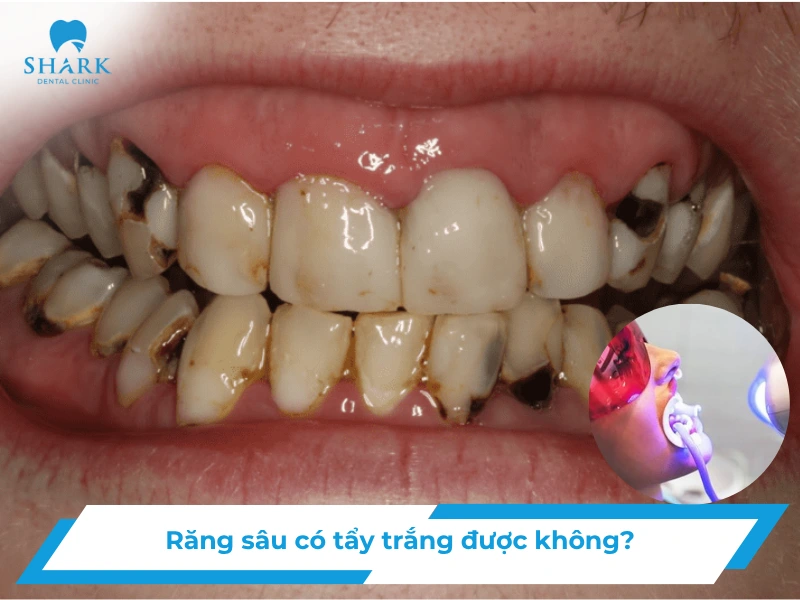 Răng sâu có tẩy trắng được không