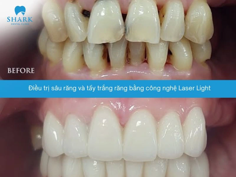 Răng của anh Hoàng trước và sau khi thực hiện tẩy trắng của khách hàng tại Nha khoa Shark