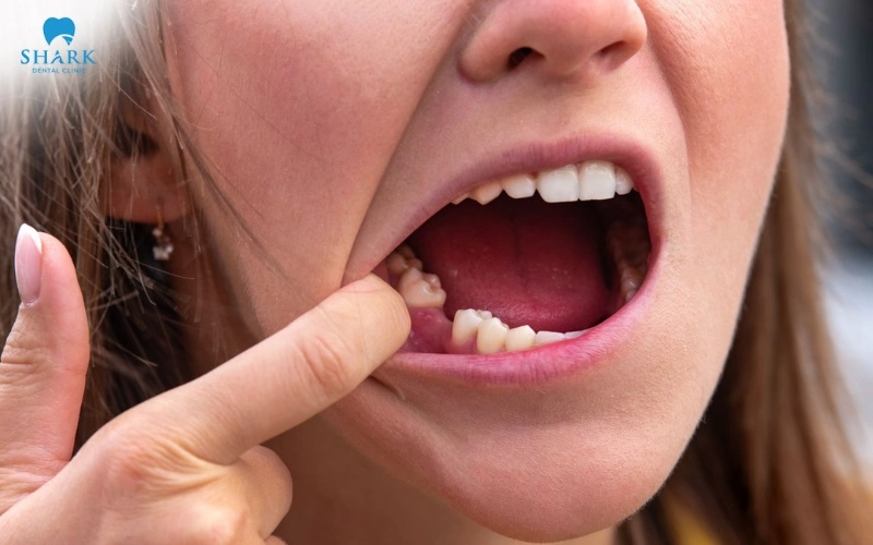 Răng số 5 có thay không? Cách phục hình răng số 5 hiệu quả 8 Răng số 5 ở người trường thành