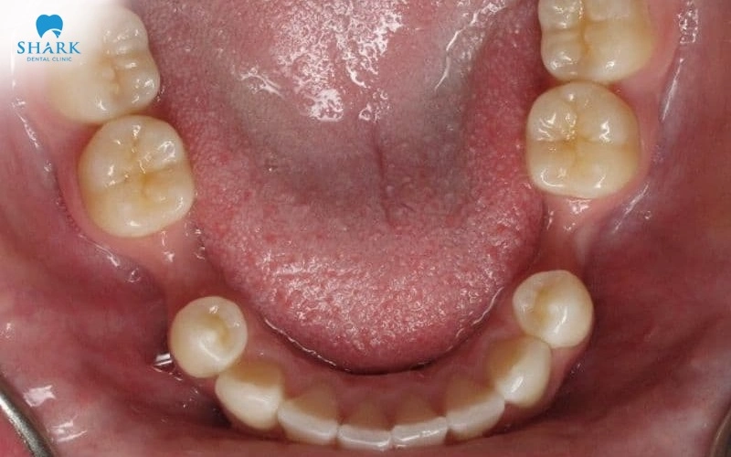 Răng số 5 có thay không? Cách phục hình răng số 5 hiệu quả 10 Mất răng số 5