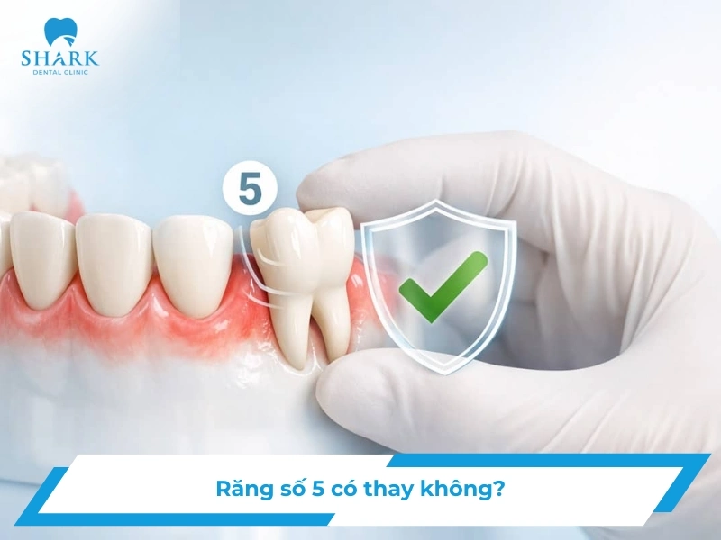 Răng số 5 có thay không