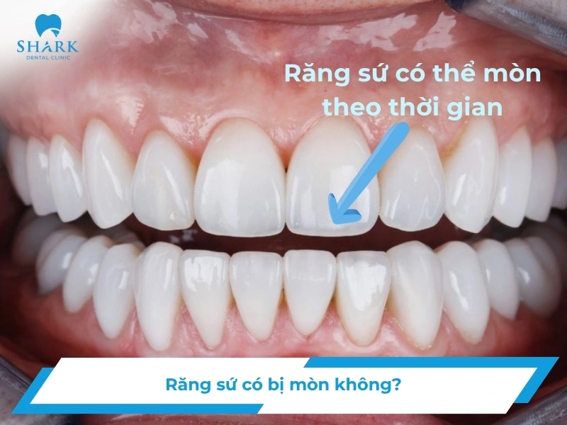 Răng sứ có bị mòn không