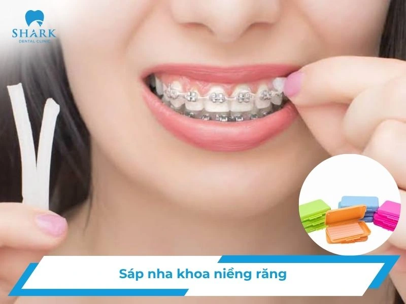 sáp nha khoa niềng răng