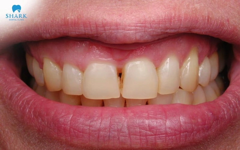 Sâu răng cửa nên trám hay bọc răng sứ để phục hình? 6 Răng cửa bị sâu nhưng chưa phá hủy vùng rìa của răng cửa, cần thực hiện trám để phục hình lại răng