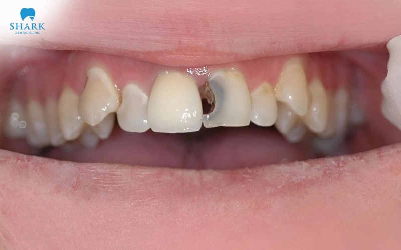Sâu răng cửa nên trám hay bọc răng sứ để phục hình? 7 Với trường hợp sâu răng đã làm mất từ một nửa cấu trúc thân răng trở lên cần thực hiện bọc răng sứ để bảo tồn răng