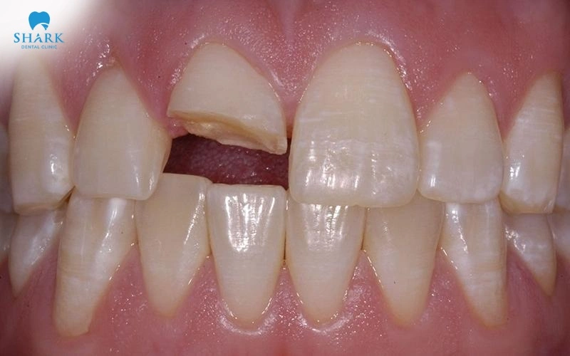 Sâu răng cửa nên trám hay bọc răng sứ để phục hình? 8 Cố chấp trám răng sẽ khiến răng cửa của bạn sẽ dễ bị nứt vỡ, gây khó khăn trong việc ăn nhai và sinh hoạt hằng ngày