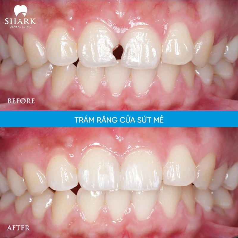 Sâu răng cửa nên trám hay bọc răng sứ để phục hình? 9 Răng của anh Khánh trước và sau khi phục hình răng cửa tại Nha khoa Shark