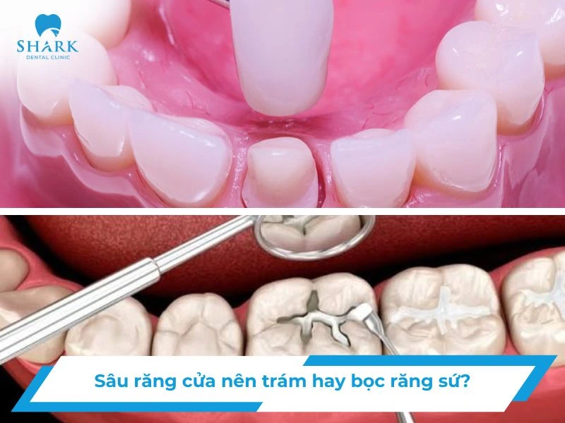sâu răng cửa nên trám hay bọc răng sứ