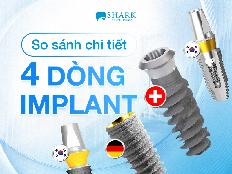 Bảng so sánh chi tiết và tổng hợp nhanh của 4 hãng trụ Implant