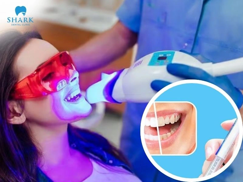 Tẩy trắng răng bằng công nghệ BleachBright có ưu điểm gì? 6 Công nghệ BleachBright sử dụng ánh sáng LED kết hợp cùng gel tẩy trắng chuyên dụng giúp đẩy nhanh quá trình làm trắng răng