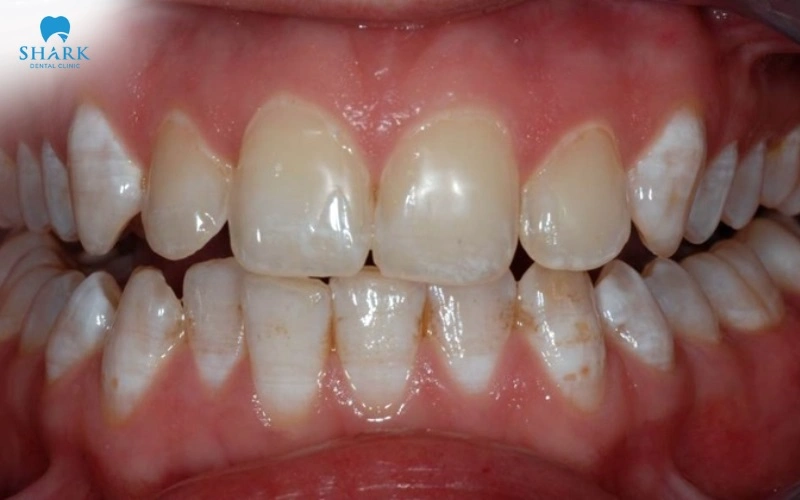 Tẩy trắng răng bằng công nghệ BleachBright có ưu điểm gì? 7 Phương pháp này là lựa chọn phù hợp cho những khách hàng có răng bị xỉn màu, ố vàng khiến nụ cười kém hài hòa