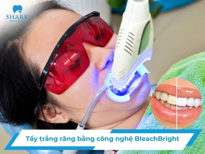 Tẩy trắng răng bằng công nghệ BleachBright có ưu điểm gì? 19 Tẩy trắng răng bằng công nghệ BleachBright