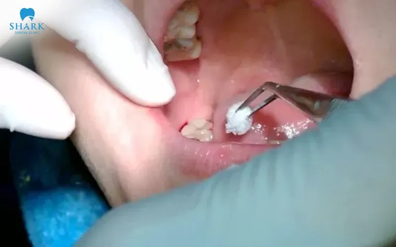 Thủng xoang hàm sau khi nhổ răng khôn có nguy hiểm không? 13 Kỹ thuật nhổ răng không chuẩn xác, dùng lúc quá mạng có thể làm vỡ phần xương ngăn cách giữa chân răng và xoang hàm