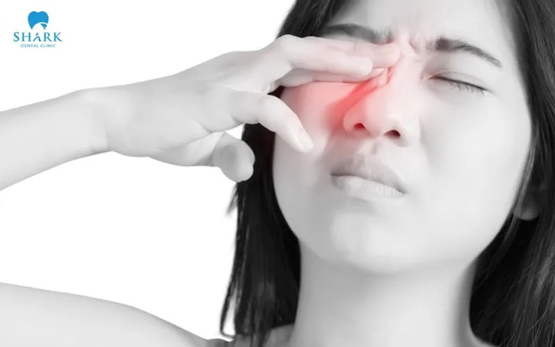 Thủng xoang hàm sau khi nhổ răng khôn có nguy hiểm không? 15 Cảm giác đau âm ỉ hoặc căng tức ở vùng má, dưới hốc mắt hoặc lan lên thái dương là những dấu hiệu điển hình cho thủng xoang hàm