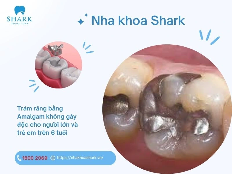 trám răng bằng amalgam không gây độc cho người lớn và trẻ em trên 6 tuổi