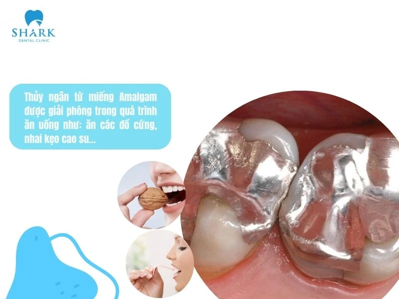 Thủy ngân từ miếng trám Amalgam thường được giải phóng khi răng chịu tác động cơ học như nhai thức ăn cứng, nhai kẹo cao su, nghiến răng,...
