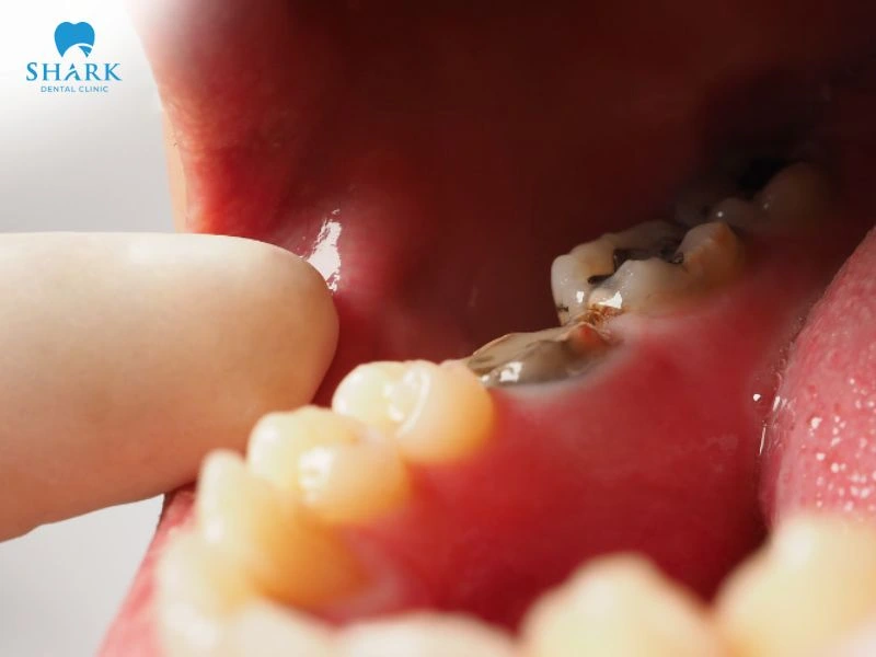 Miếng trám răng bị đem là một trong dấu hiệu rõ ràng cho thấy miếng trám amaglam đang đi rò rỉ