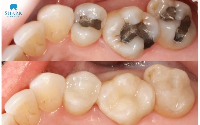 Răng của anh Thanh trước và sau khi thực hiện tháo gỡ trám răng Amalgam tại Nha khoa Shark
