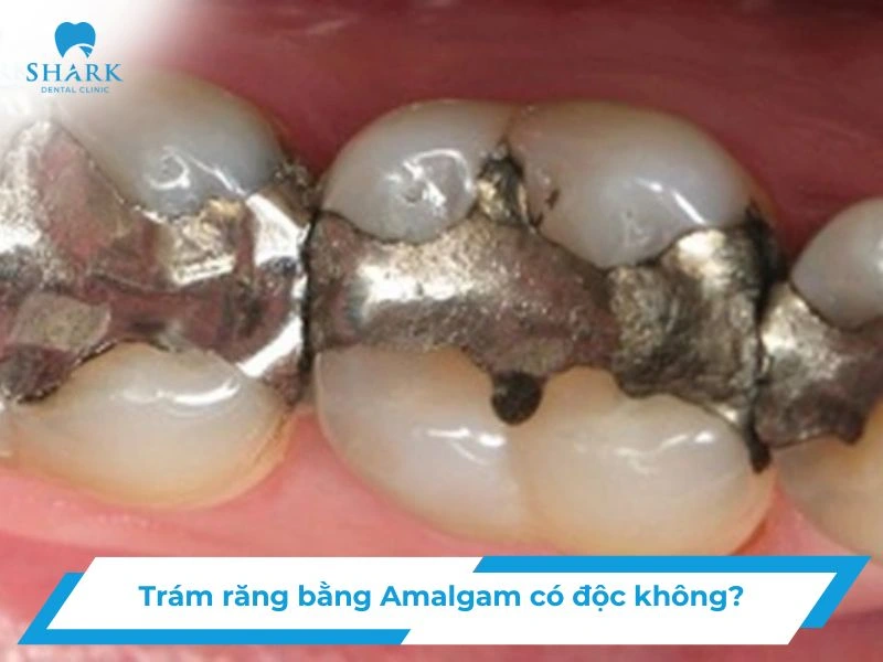 trám răng bằng amaglam có độc không
