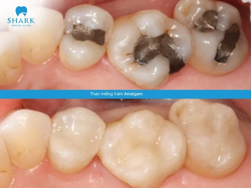 Răng của anh Thanh trước và sau khi thực hiện tháo gỡ trám răng Amalgam tại Nha khoa Shark