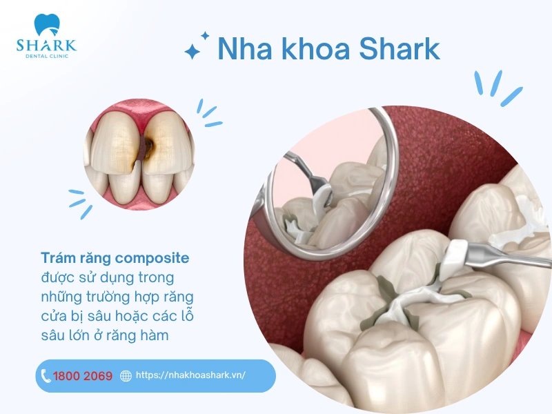 Trám răng Composite thường được sử dụng trong các trường hợp cần tính thẩm mỹ cao như sâu răng cửa hoặc các lỗ sâu lớn ở răng hàm
