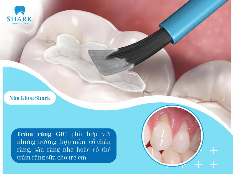 Đối với trám răng GIC thường phù hợp với các trường hợp mòn cổ chân răng, sâu răng nhẹ hoặc trám răng sữa ở trẻ em