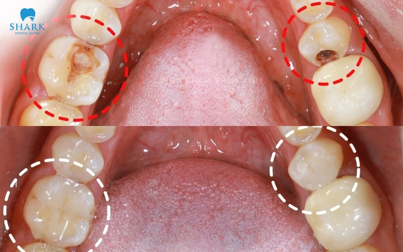 Răng của chị Vân Anh trước và sau khi thực hiện trám răng tại Nha khoa Shark