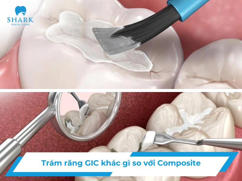 Trám răng GIC khác gì so với Composite? Nên chọn loại nào? 33 trám răng gic khác gì so với composite