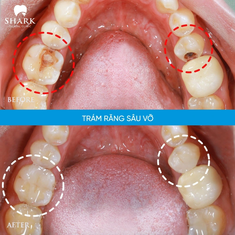 Sâu răng nhẹ đánh răng có hết không? Giải đáp y khoa 10 Trám răng sâu