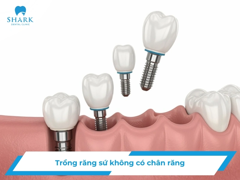 Trồng răng sứ không có chân răng bằng phương pháp nào tốt nhất? 15 Trồng răng sứ không có chân răng