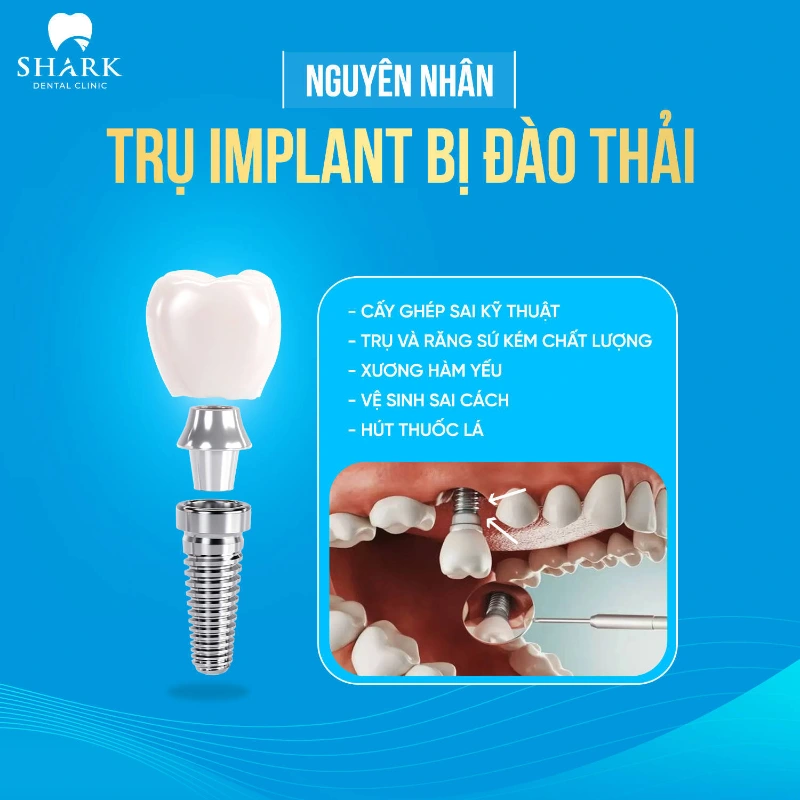 Trồng răng Implant giá bao nhiêu? Bảng giá cấy ghép răng mới 7 Trụ răng bị đào thải