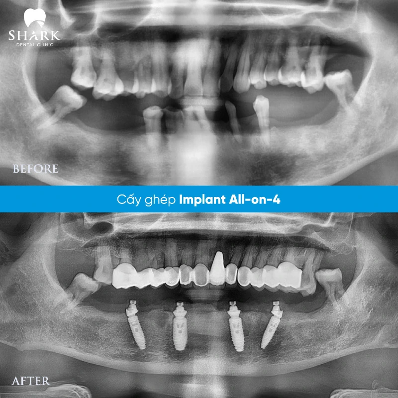 Trồng răng sứ không có chân răng bằng phương pháp nào tốt nhất? 10 X-quang Cấy ghép Implant All on 4 của chú Hùng