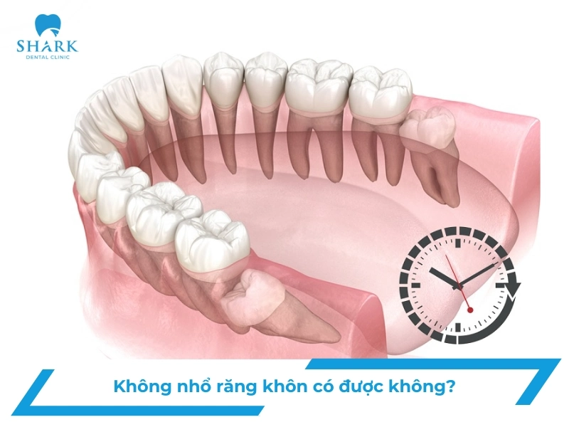 Không nhổ răng khôn có sao không? Khi nào cần nhổ gấp? 13 Không nhổ răng khôn có sao không
