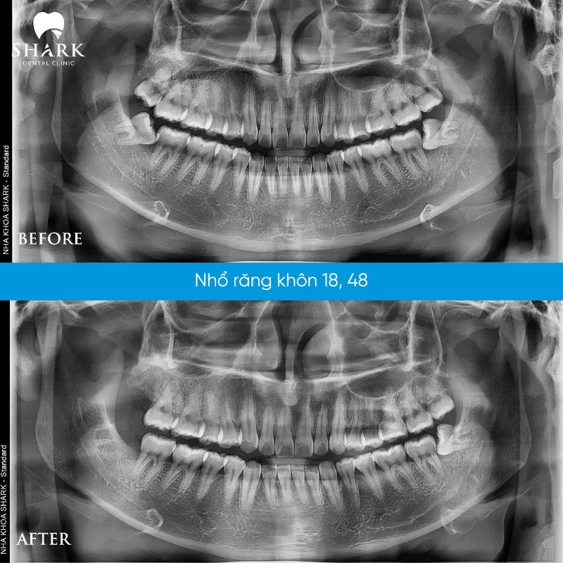 Trước và sau khi thực hiện ca tiểu phẫu răng khôn của Chị Tiên
