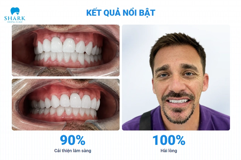 Bọc hơn 16 răng sứ cho khách hàng tại Shark