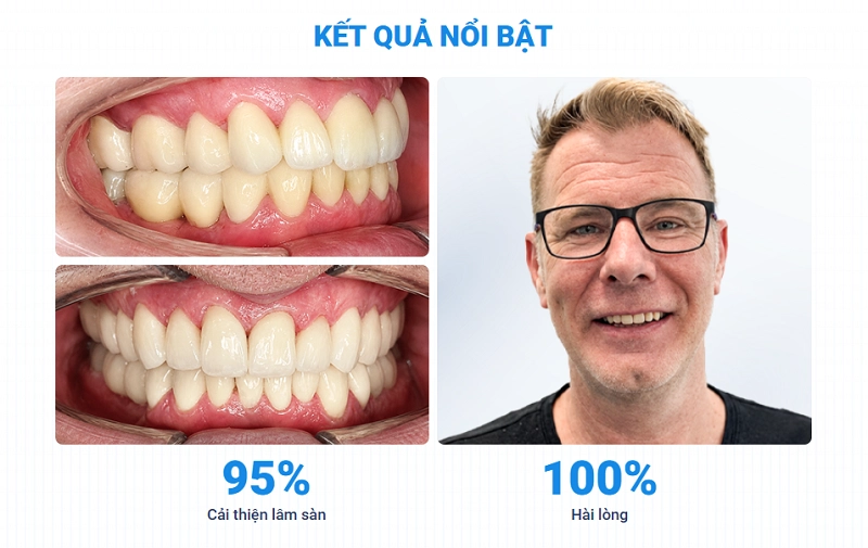 Bọc 26 răng sứ Lava Plus 3M cho anh Conal McCullough