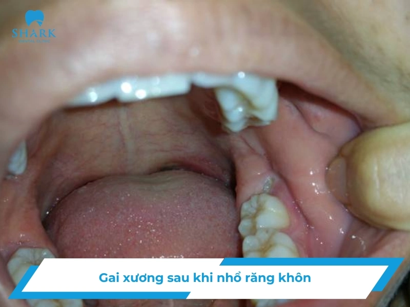 Gai xương sau nhổ răng khôn có nguy hiểm không? Bao lâu hết? 9 gai xuong sau nho rang khon