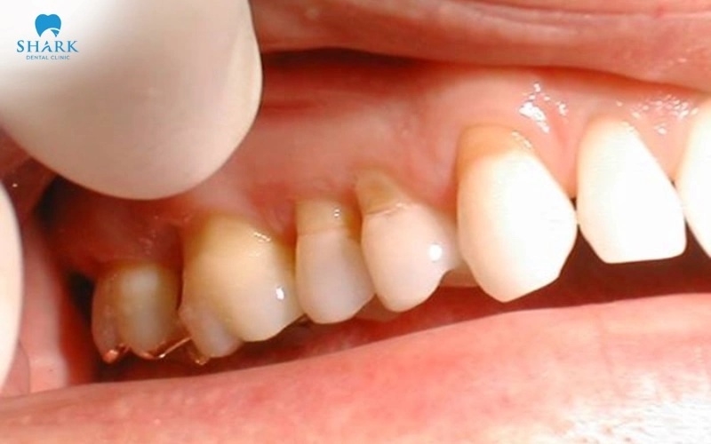 Ghép nướu là gì? Chi phí ghép lợi là bao nhiêu tiền? 7 Tụt nướu là hiện tượng thường gặp