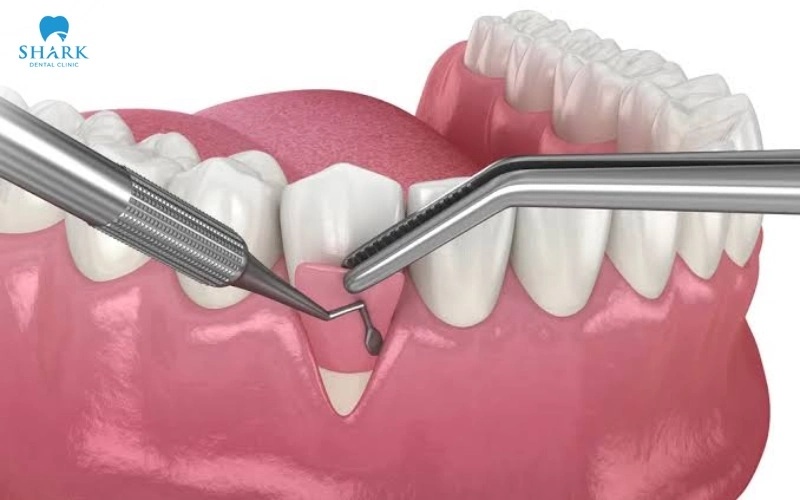 Ghép nướu là gì? Chi phí ghép lợi là bao nhiêu tiền? 8 Phương pháp ghép nướu bằng kỹ thuật ghép mô liên kết