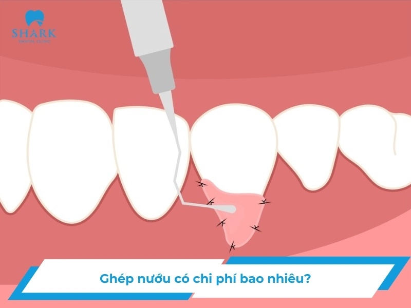 Ghép nướu