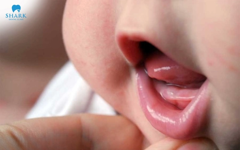 Dấu hiệu và hình ảnh lợi trẻ sắp mọc răng cửa, răng hàm 11 Lợi có màu trắng và phồng nhẹ