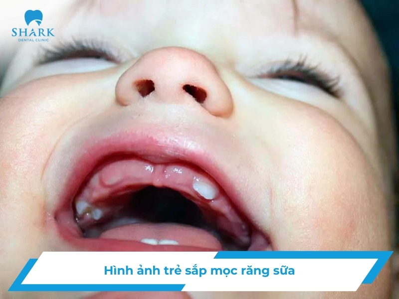 Lợi trẻ sắp mọc răng cửa