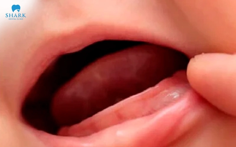 Hình ảnh trẻ bị nanh sữa: Các dấu hiệu nhận biết chuẩn 16 Nanh sữa lành tính