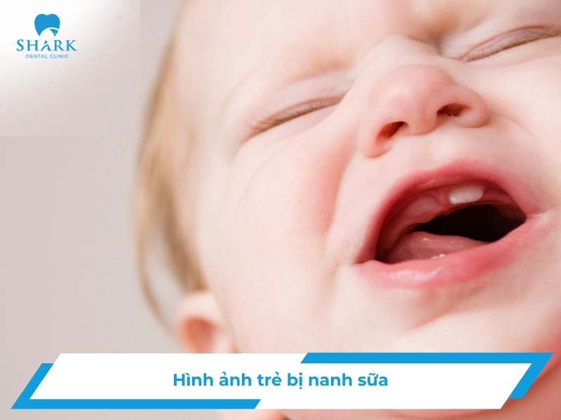 Hình ảnh trẻ bị nanh sữa: Các dấu hiệu nhận biết chuẩn 17 hình ảnh trẻ bị nanh sữa