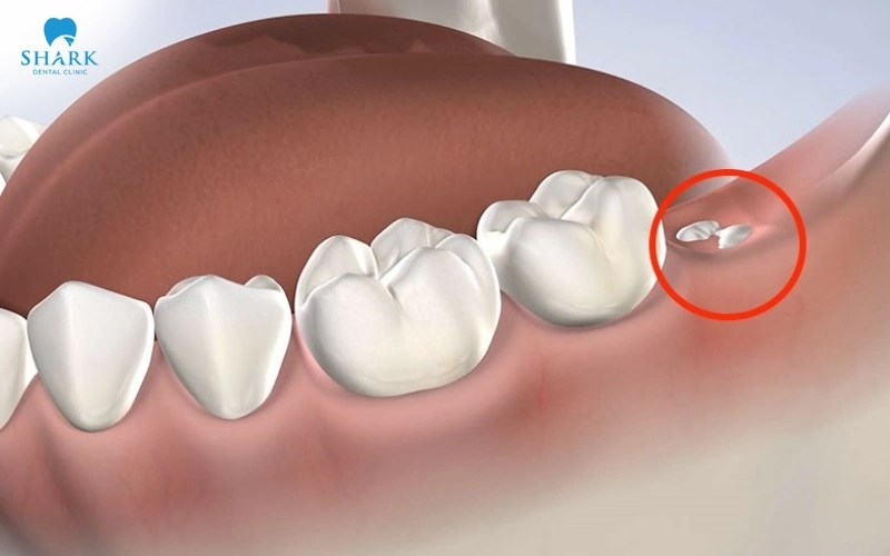 Không nhổ răng khôn có sao không? Khi nào cần nhổ gấp? 5 Không nhổ răng khôn có sao không?