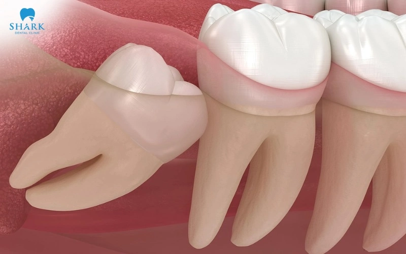 Không nhổ răng khôn có sao không? Khi nào cần nhổ gấp? 7 Răng khôn mọc lệch gây tổn thương răng số 7