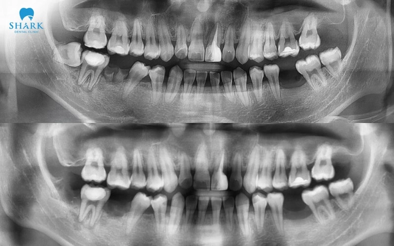 Không nhổ răng khôn có sao không? Khi nào cần nhổ gấp? 6 So sánh răng khôn mọc thẳng và mọc lệch trên phim X quang
