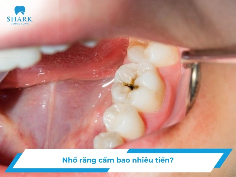 Nhổ răng cấm giá bao nhiêu