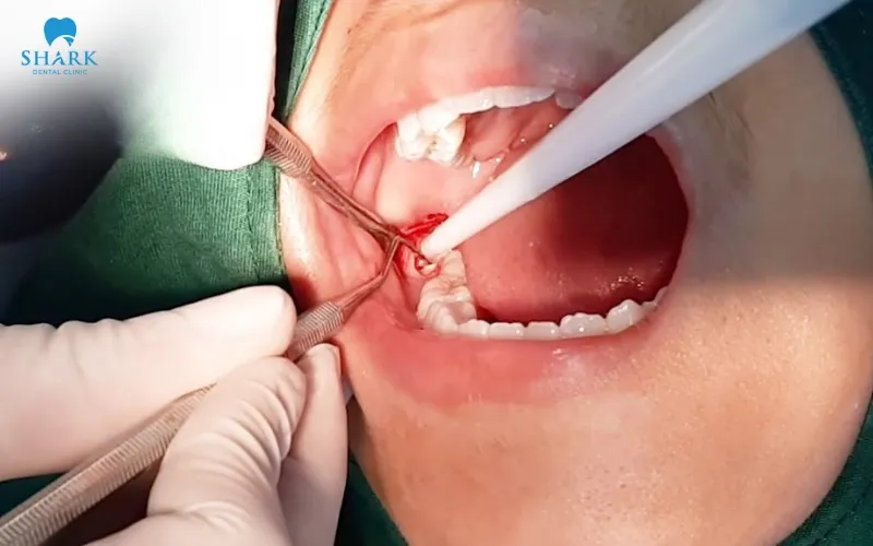 Bác sĩ thực hiện có tay nghề và chuyên môn chưa cao là một trong những nguyên nhân dẫn đến nguy hiểm khi nhổ răng